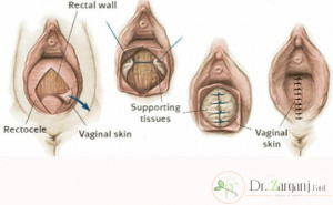 پرینورافی در مطب چگونه است؟
