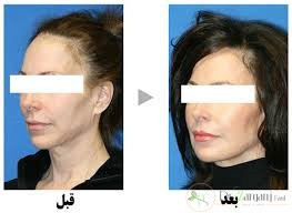 علت گلوله شدن ژل خط خنده