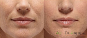 رعایت نکردن اقدامات مهم پس از تزریق ژل خنده چه عوارضی بر پوست می گذارد؟
