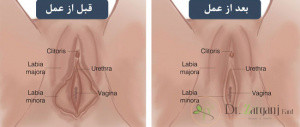 هزینه لابیا ماژور پلاستی