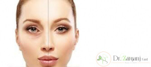 چرا تزریق ژل در زیر چشم انجام می گیرد؟