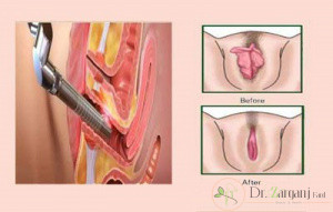 مزیت های عمل پرینورافی چیست؟