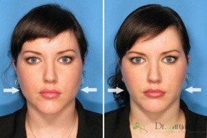 به طور معمول، برای زاویه سازی صورت گرد، چه افرادی به این روش تمایل دارند ؟