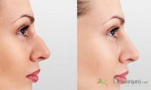 بهبود بینی با نخ به شیوه ی دوبل