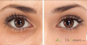 فواید تزریق ژل زیر چشم