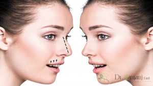 هزینه لیفت بینی بدون جراحی