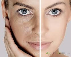 عوارض بعد از انجام کربوکسی تراپی چیست؟