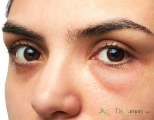 روش کربوکسی تراپی ماندگاری آن تا چه زمانی است؟