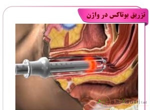 تزریق بوتاکس در واژن چه فوایدی دارد؟