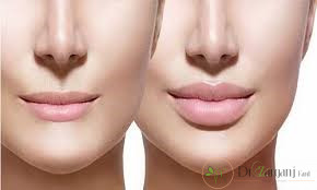 عمل تزریق ژل