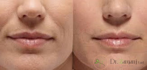 مراقبت های بعد از تزریق ژل خط خنده