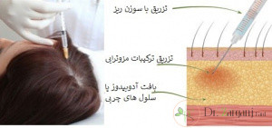 چه کسانی نمی توانند مزوتراپی را انجام دهند؟