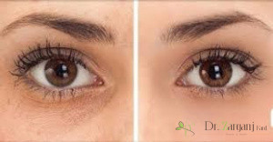 چرا امروزه، از ژل های تزریقی بیشتر استفاده می شود؟