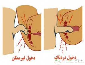 واژینیسموس چگونه می باشد؟