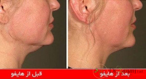 مزایای هایفوتراپی چیست؟