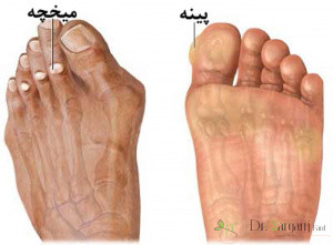 فرق میان میخچه با پینه در چیست؟