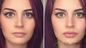 کاربردهای استفاده از فیلر نورامیس چیست؟