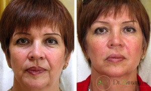 تزریق ژل برای رفع خط خنده