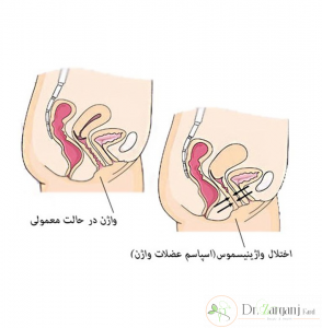 تمرینات واژینیسموس
