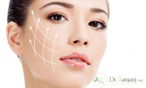 اقدامات پس از تزریق ژل خط خنده