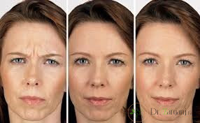 قبل از تزریق ژل چه نکاتی را باید رعایت کرد؟