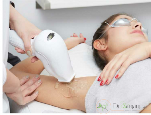 لیزر دکا بهتر است یا کندلا؟