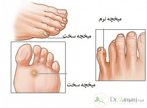چه عواملی باعث ایجاد میخچه های پا می شود؟