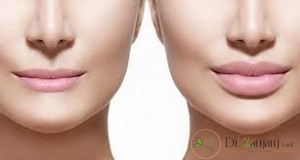طریقه تزریق فیلر نورامیس چیست؟