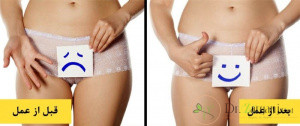 چه نکاتی را جهت جلوگیری از عفونت بخیه واژن باید رعایت کرد؟