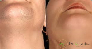 آیا لیزر موهای زائد چانه دردناک است؟
