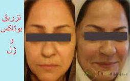 بوتاکس تقلبی
