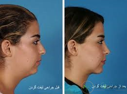 1.لیفت گردن چیست؟