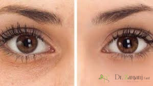 4ـ برای تمدید تزریق ژل زیر چشم پرفکتا چه زمانی باید مراجعه نمود؟