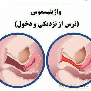 انواع واژينيسموس کدام اند؟