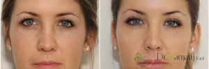 مراقبت های بعد از تزریق ژل زیر چشم؟