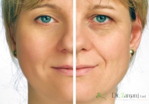 عوارض ژل های تزریقی کدام اند ؟