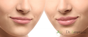 انواع ژل های تزریقی برای لب چه نوع ژل هایی هستند؟