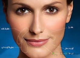 تزریق ژل خط خنده با چه موادی صورت می گیرد؟