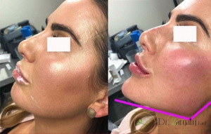 کاربرد ژل پرفکتا کامپلیمنت چیست؟