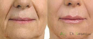 عوارض تزریق ژل خط خنده