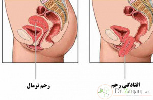 عوارض رکتوسل یا پرینورافی چیست؟
