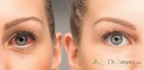 3ـ افراد پس از تزریق ژل زیر چشم پرفکتا چه نکاتی را باید رعایت کنند؟