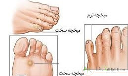میخچه چیست و چه تفاوتی با پینه دارد؟