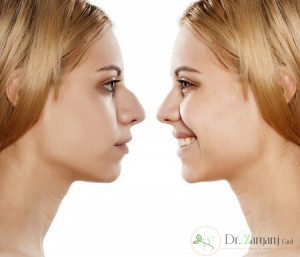 مزایای استفاده از لیفت بینی با ژل به جای عمل جراحی کدام موارد هستند؟