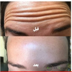 چند توصیه برای بوتاکسی ها چیست؟