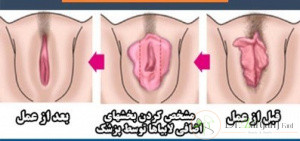 عمل لابیا پلاستی در کرج چگونه است؟