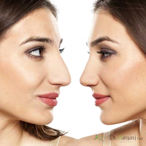 5: لیفت بینی بدون جراحی چه نتایجی به دنبال دارد؟