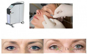استفاده از روش کربوکسی تراپی دربیمار ممکن است با عفونت همراه باشد ؟