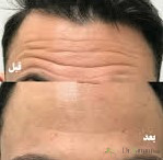 بوتاکس درماتکس