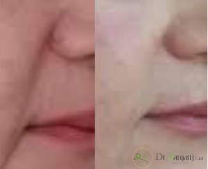 چه زمانی می توان، بعد از تزریق ژل، صورت را شستشو داد؟